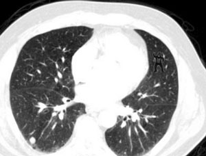 Radiologists and the Invisible Gorilla